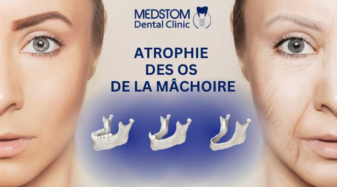 atrophie-des-os-de-la-mchoire-causes-frquentes-prvention-et-traitement-dentaire